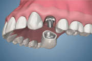 Implant Placement Left Premolar Metal Post and Core and Crown